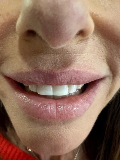 Smile Gallery - Composite Repair 1 After