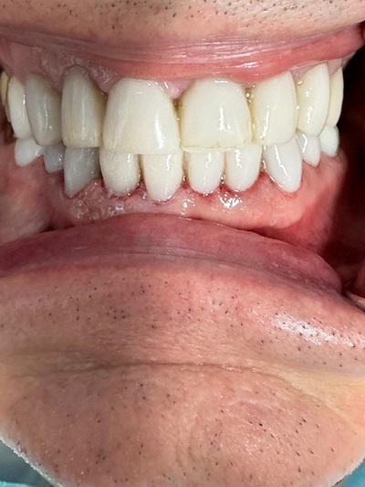 Smile Gallery - Composite Veneer 1 After