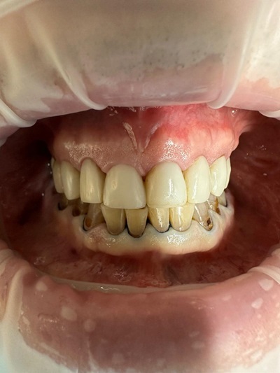 Smile Gallery - Composite Veneer 1 Before