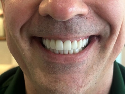 Smile Gallery - Full Mouth Reconstruction 1 After