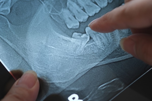 Does Wisdom Tooth Extraction Require Invasive Surgery?